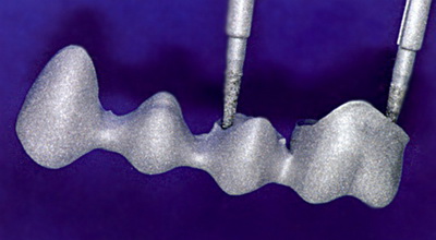 металлокерамические протезы